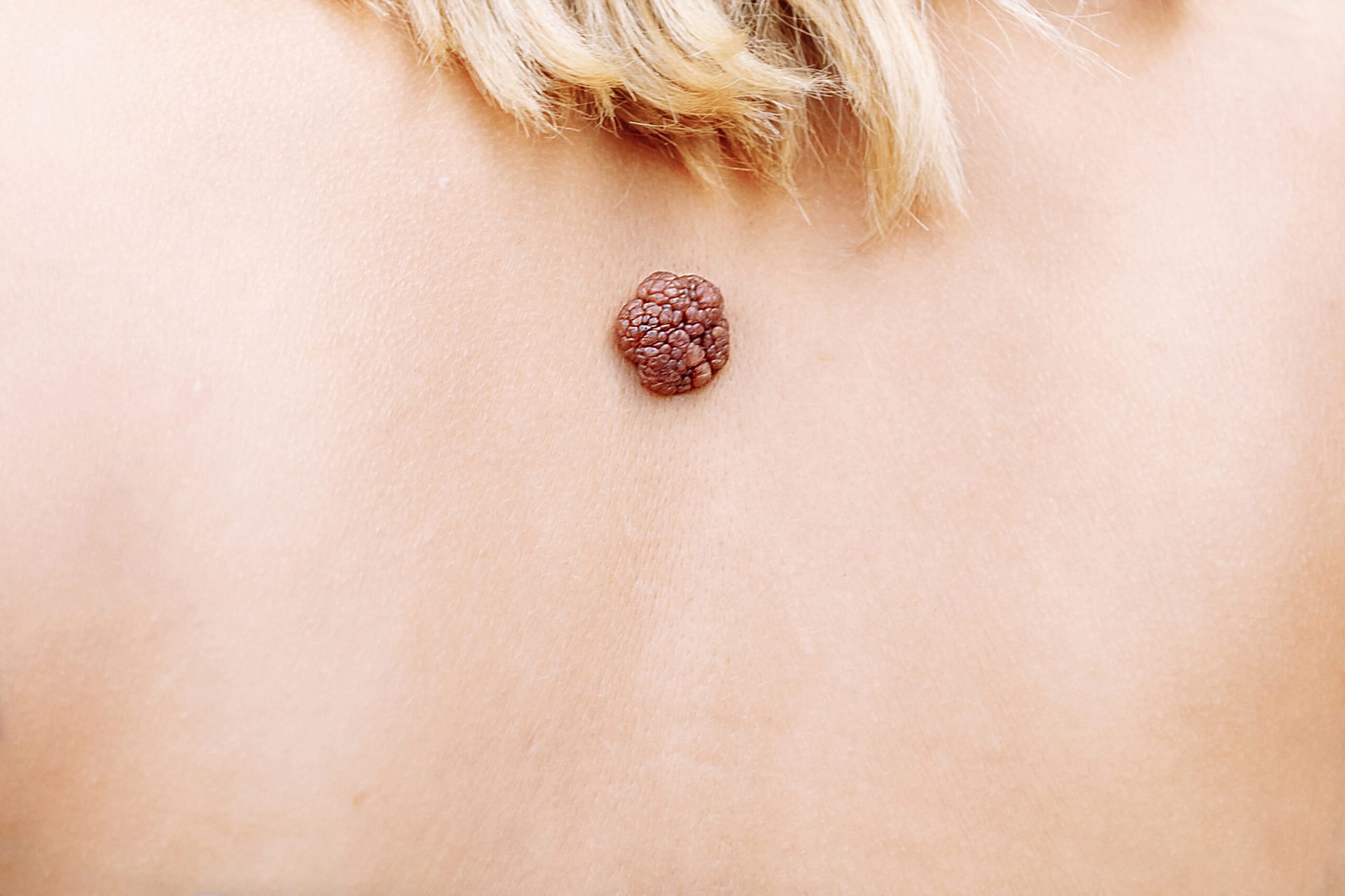 De que se alimenta un tumor canceroso