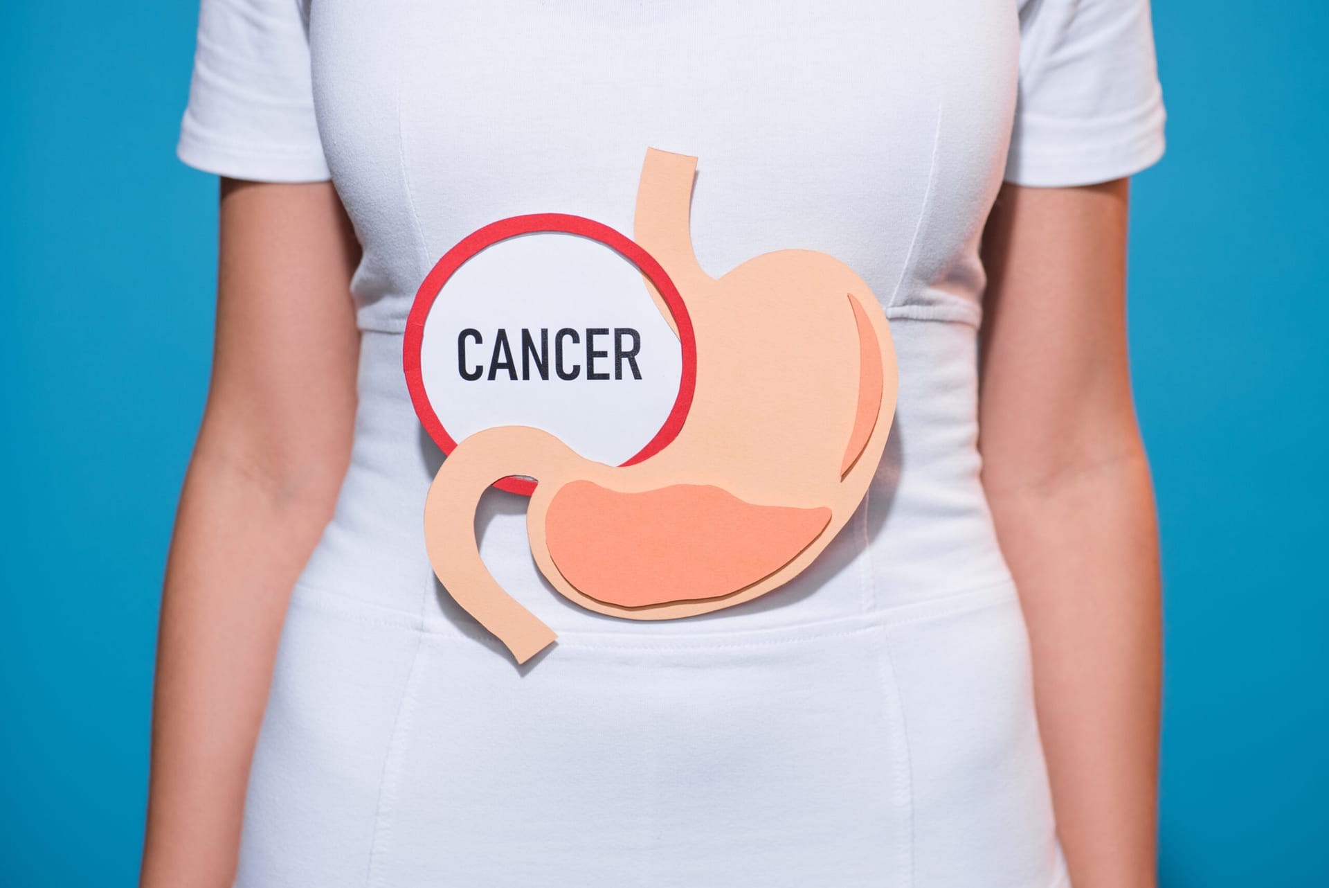 tratamiento nutricional para el cáncer gástrico